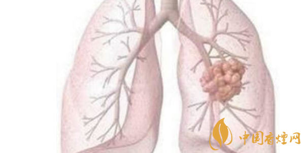 吸烟与肺癌的关系研究 与吸烟关系最为密切的肺癌是鳞癌