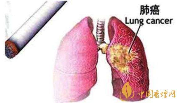 吸烟与肺癌的关系_吸烟与肺癌的关系研究 与吸烟关系最为密切的肺癌是鳞癌