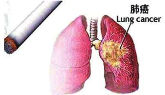 吸烟与肺癌的关系研究 与吸烟关系最为密切的肺癌是鳞癌