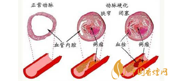 吸烟对血管的危害大吗 五大吸烟对血管壁的危害